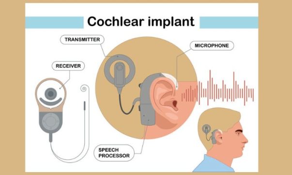image of cochlear implant