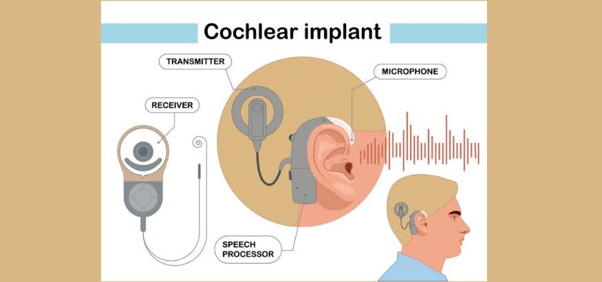 image of cochlear implant